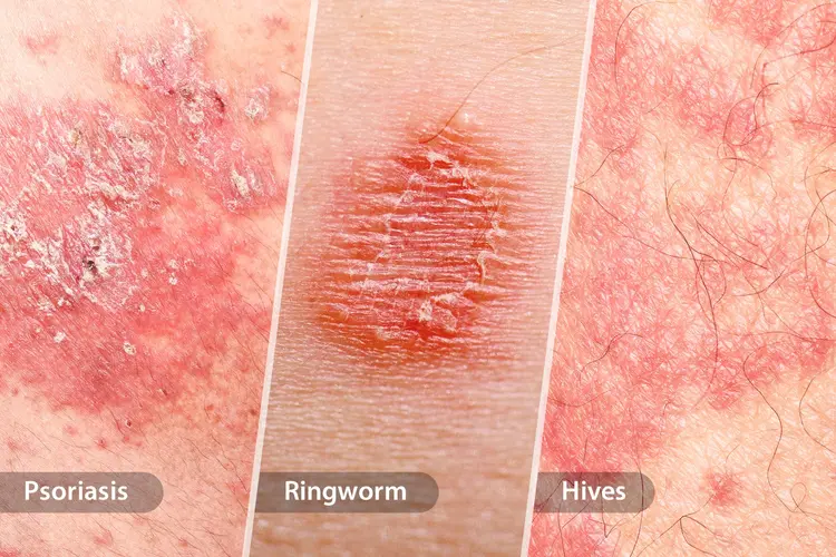 Skin Conditions Homeopathy Treatment