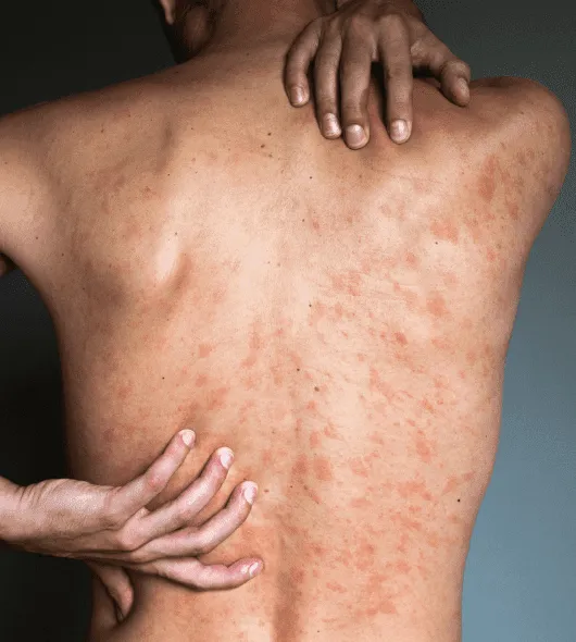 Electrohomeopathy for Skin Conditions